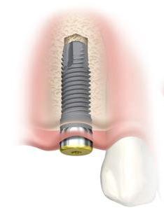 implants dentaires